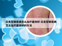 红皮型银屑病怎么治疗最快好 红皮型银屑病怎么治疗最快好的方法