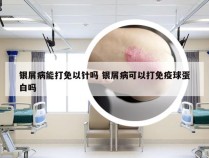 银屑病能打免以针吗 银屑病可以打免疫球蛋白吗