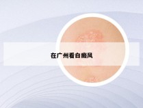 在广州看白癜风