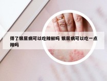 得了银屑病可以吃辣椒吗 银屑病可以吃一点辣吗
