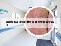 银屑病怎么治郑州银屑病 郑州银屑病专病门诊