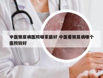 中医银屑病医院哪家最好 中医看银屑病哪个医院较好