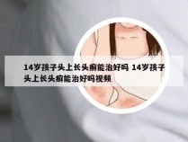 14岁孩子头上长头癣能治好吗 14岁孩子头上长头癣能治好吗视频