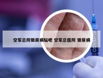 空军总院银屑病贴吧 空军总医院 银屑病