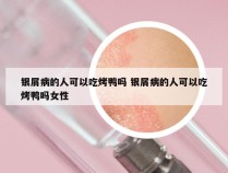 银屑病的人可以吃烤鸭吗 银屑病的人可以吃烤鸭吗女性