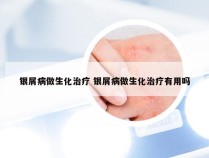 银屑病做生化治疗 银屑病做生化治疗有用吗