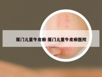 厦门儿童牛皮癣 厦门儿童牛皮癣医院