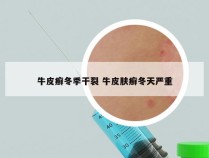 牛皮癣冬季干裂 牛皮肤癣冬天严重