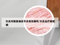 针灸对银屑病关节炎有效果吗 针灸治疗银屑病