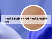 牛皮癣患者遗传下一代吗 牛皮癣遗传的概率大吗