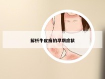 解析牛皮癣的早期症状