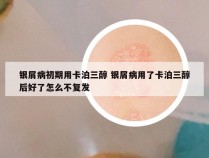 银屑病初期用卡泊三醇 银屑病用了卡泊三醇后好了怎么不复发