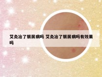 艾灸冶了银屑病吗 艾灸冶了银屑病吗有效果吗