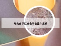 龟头皮下红点会不会是牛皮癣