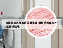 b银屑病怎样治疗效果更好 银屑病怎么治才能断根贴吧