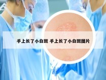 手上长了小白斑 手上长了小白斑图片