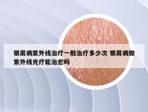 银屑病紫外线治疗一般治疗多少次 银屑病做紫外线光疗能治愈吗