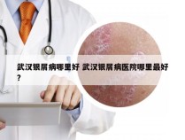 武汉银屑病哪里好 武汉银屑病医院哪里最好?