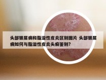 头部银屑病和脂溢性皮炎区别图片 头部银屑病如何与脂溢性皮炎头癣鉴别?