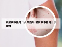 银屑病不能吃什么东西吗 银屑病不能吃什么食物