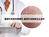 胳膊牛皮屑早期图片 胳膊牛皮肤癣怎么治疗