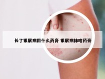长了银屑病用什么药膏 银屑病抹啥药膏