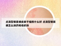 点滴型银屑病皮肤干燥擦什么好 点滴型银屑病怎么抹药吸收的快