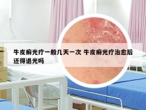 牛皮癣光疗一般几天一次 牛皮癣光疗治愈后还得退光吗