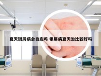 夏天银屑病会自愈吗 银屑病夏天治比较好吗