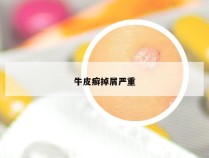 牛皮癣掉屑严重