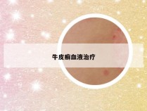 牛皮癣血液治疗