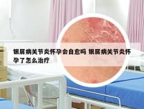 银屑病关节炎怀孕会自愈吗 银屑病关节炎怀孕了怎么治疗