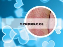 牛皮癣和脚臭的关系