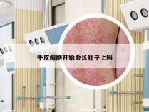 牛皮癣刚开始会长肚子上吗