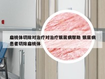 扁桃体切除对治疗对治疗银屑病帮助 银屑病患者切除扁桃体