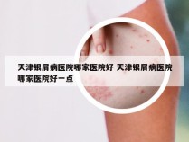 天津银屑病医院哪家医院好 天津银屑病医院哪家医院好一点