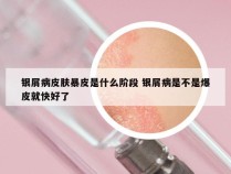 银屑病皮肤暴皮是什么阶段 银屑病是不是爆皮就快好了
