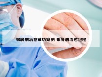 银屑病治愈成功案例 银屑病治愈过程