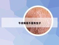 牛皮癣是不是有虫子