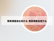 银屑病查血化验什么 银屑病查血查什么