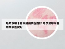 哈尔滨哪个看银屑病的医院好 哈尔滨哪家看银屑病医院好