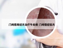 门纯德用经方治疗牛皮癣 门纯德经验方