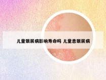 儿童银屑病影响寿命吗 儿童患银屑病