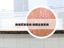 脚裸处银屑病 脚踝处银屑病