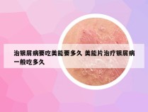 治银屑病要吃美能要多久 美能片治疗银屑病一般吃多久
