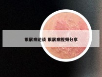 银屑病论谈 银屑病视频分享