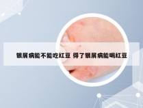 银屑病能不能吃红豆 得了银屑病能喝红豆