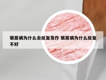 银屑病为什么会反复发作 银屑病为什么反复不好