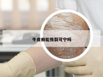 牛皮癣能擦裂可宁吗