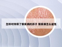 怎样对待得了银屑病的孩子 银屑病怎么避免